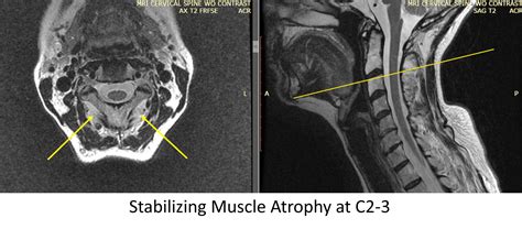 How Does The Body Stabilize The C1 C2 Joint The Role Of The Alar