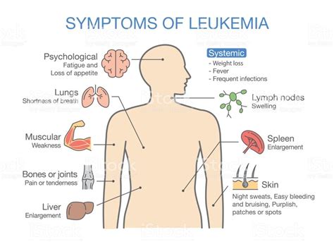 Common Symptoms And Signs Of Leukemia Medical Illustration Ideal For