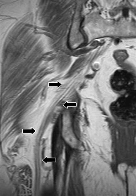 Mr Imaging Of Entrapment Neuropathies Of The Lower Extremity