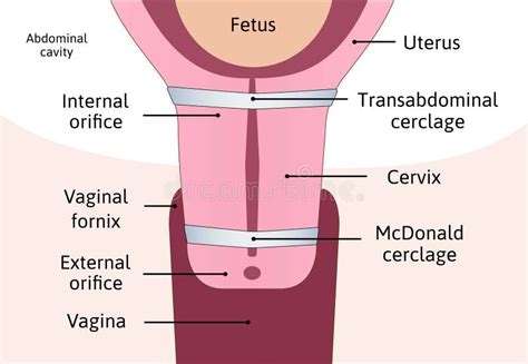 Mcdonald Cerclage Tightening Of Cervix Opening During Pregnancy Anatomy Of Cervical Canal