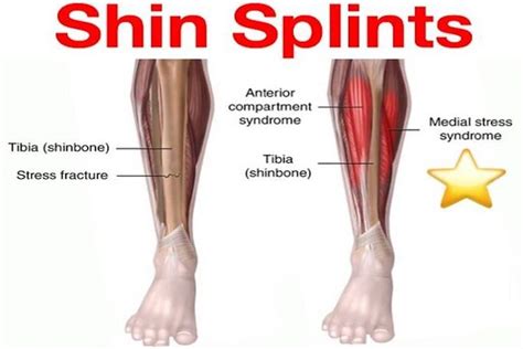 All You Need To Know About Shin Splints The Footcare Clinic