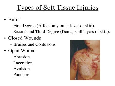 Ppt Soft Tissue Injuries Powerpoint Presentation Free Download Id 9375148
