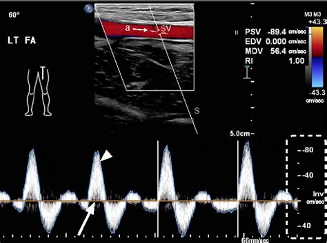Figure From Doppler Ultrasonography Of The Lower Extremity Arteries