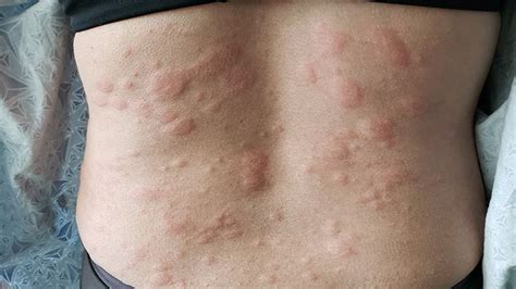 600 x 800 jpeg 70 кб. Hives Symptoms: How You Know It's Really Hives | Everyday ...