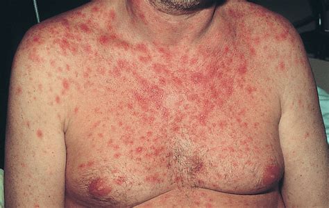 Types Of Rash Associated With An Hiv Infection