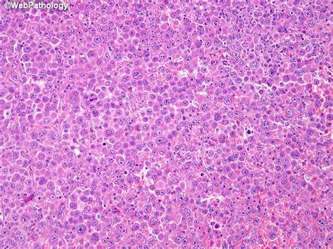 Webpathology.com: A Collection of Surgical Pathology Images