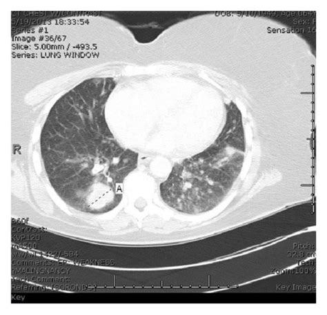 Ct Of The Chest Showing Bilateral Pulmonary Nodules Download
