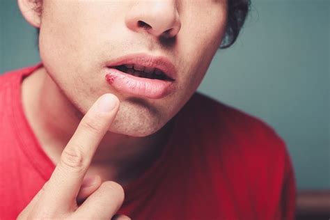 Blister On Lip Causes Treatment And Prevention