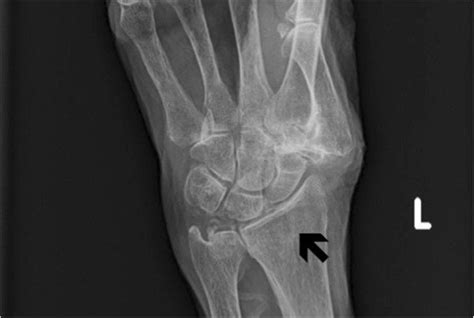 X Ray Of The Left Wrist A Non Displaced Fracture Of The Left Distal