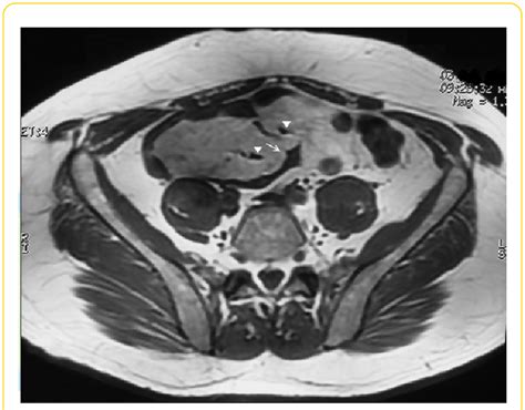 Axial T1 Weighted Mr Image Showing The Mass With Intermediate Low