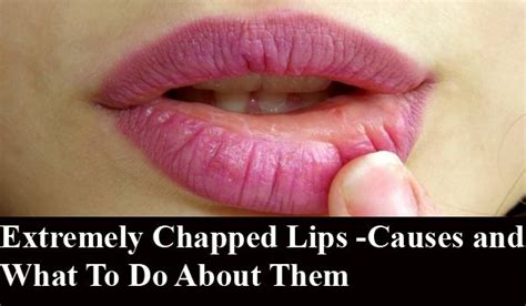 Extremely Chapped Lips Causes And What To Do About Them How To Line Lips Lips Remedies Uses