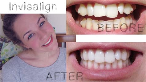 If your childs need for orthodontics is clearly hindering their overall health, the work might be covered. My Invisalign Treatment - YouTube