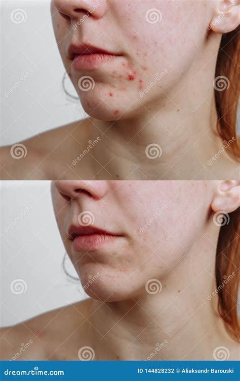 Young Woman Before And After Acne Treatment Closeup Skin Care Concept