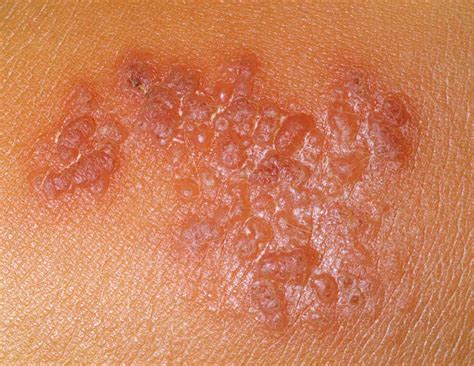 Itchy Bumps Filled With Clear Liquid Causes And Treatment