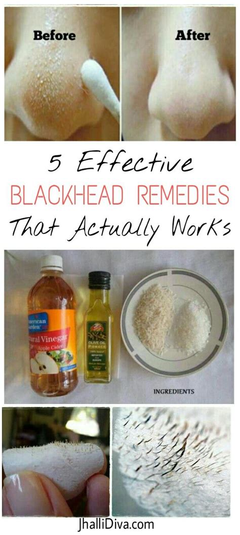 Hair Removal Permanent Facials 5 Effective Blackhead Removal Remedies