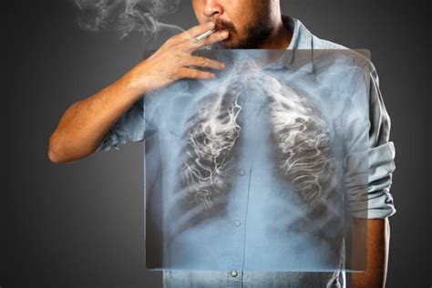 Early Signs Of Lung Cancer Everyone Should Know About Page