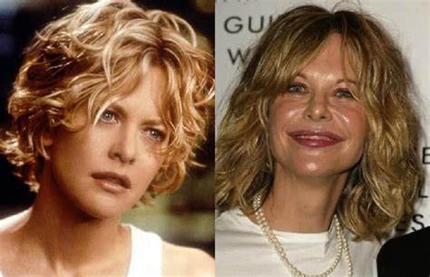 Meg Ryan Before And After Plastic Surgery