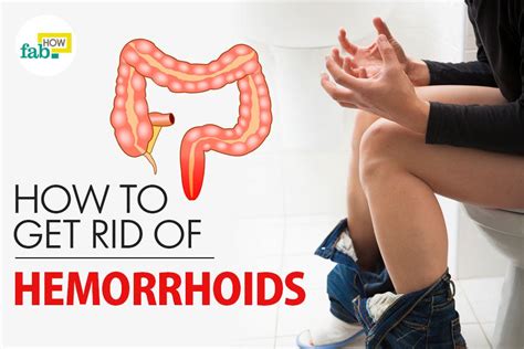 How To Get Rid Of Hemorrhoids Without Surgery Fab How