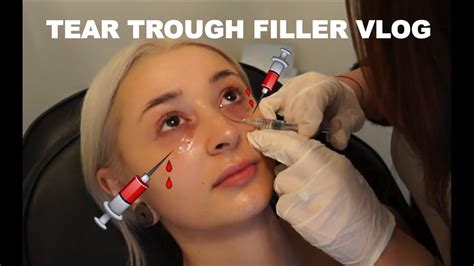 Tear Trough Filler Vlog Makeup By Delite Youtube