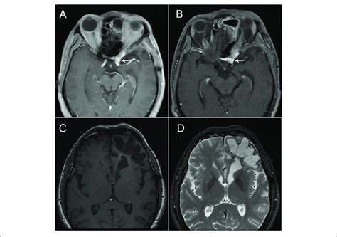 A Brain Magnetic Resonance Imaging Mri T1 Weighted Sequence After