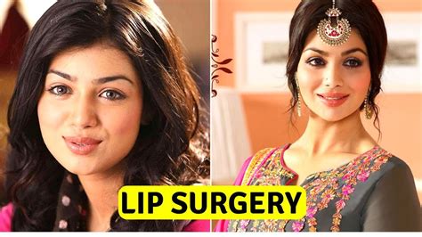 Actresses With Lip Fillers