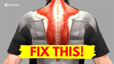 How To Fix Muscle Knots In Your Neck Shoulder In Seconds Spinecare