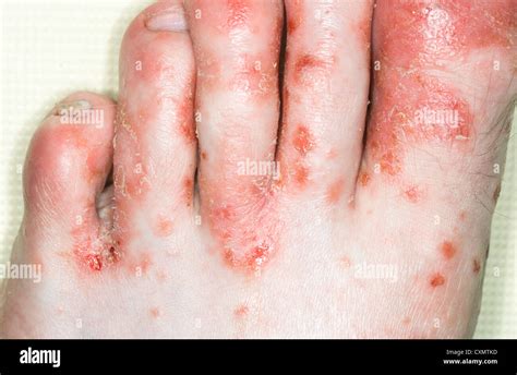 Staphylococcal Infection Of Foot Secondary To Eczema Model Released