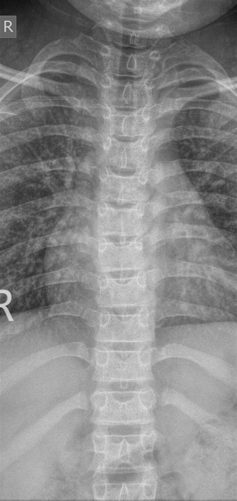 Normal Thoracic Spine X Ray 9 Year Old Image