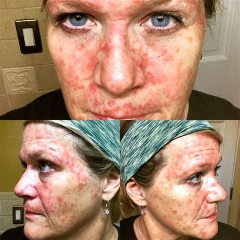 Mom Shows What Treating Pre Cancer With Chemo Cream Looks Like