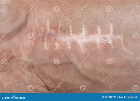 Scar With Stitches On The Wrist After Surgery Fracture Of The Bones Of