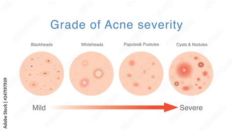Acne Severity Scale How Bad Is Your Acne My Xxx Hot Girl