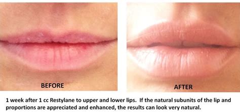 Pin By Bambi On Cosmetic Procedures Lip Injections Lip Augmentation