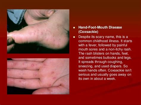 Itchy Bumpy Rash On Hands And Feet Rash 22 Common Skin Rashes