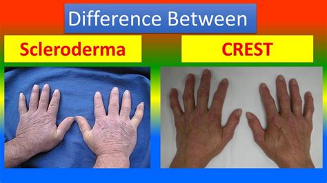 Difference Between Scleroderma And Crest Syndrome Youtube