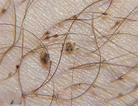 Pubic Lice Or Crab Lice Signs Symptoms Transmission Pubic Lice