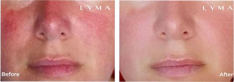 Rosacea Laser Treatment Review By Jancee Dunn