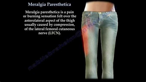 Meralgia Paresthetica Everything You Need To Know Dr Nabil