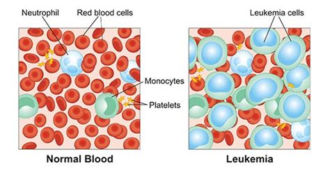 Leukemia Information