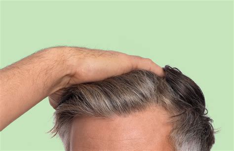 The Various Stages Of Hair Loss 15 Minutes By Cornerstone