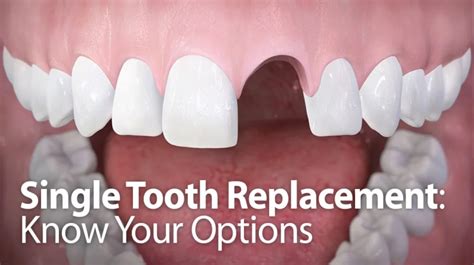Single Tooth Replacement Options Springvale Dental Clinic