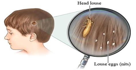 Diy Doctors Wont Tell You This Cheap Way To Get Rid Of The Head Lice