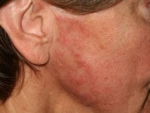 Shows the discoloration of the skin on the face. Tinea faciei | DermNet NZ