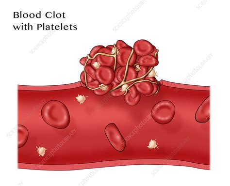 Blood Clot Stock Image C0306742 Science Photo Library