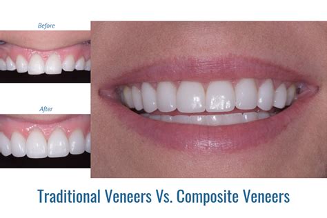 Traditional Veneers Vs Composite Veneers Riverside Dental