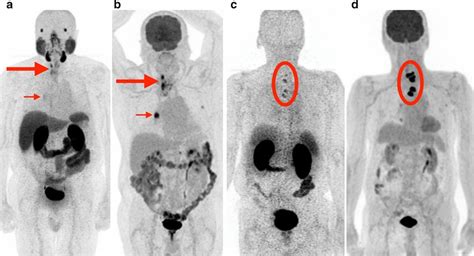 Patients With Metastatic Thyroid Cancer With Greater Fdg Uptake Than