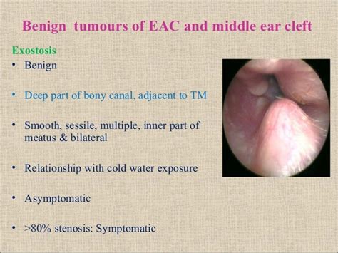 Tumours Of External And Middle Ear