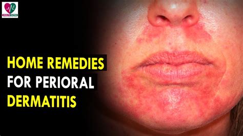 Home Remedies For Perioral Dermatitis Health Sutra Best Health Tips