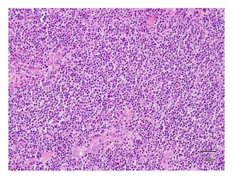 Histology Demonstrating Lymphoid Infiltrate With A Diffuse And Vaguely