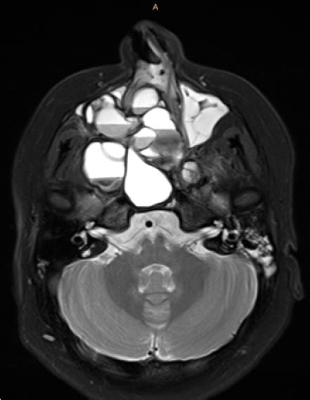Rare Case Of An Aneurysmal Bone Cyst Of The Skull