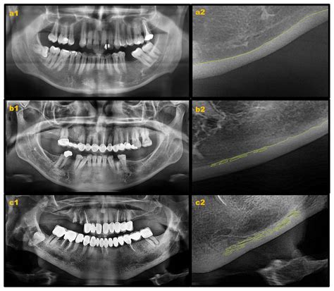 Evaluation Of Change In Trabecular Bone Structure Surrounding Dental